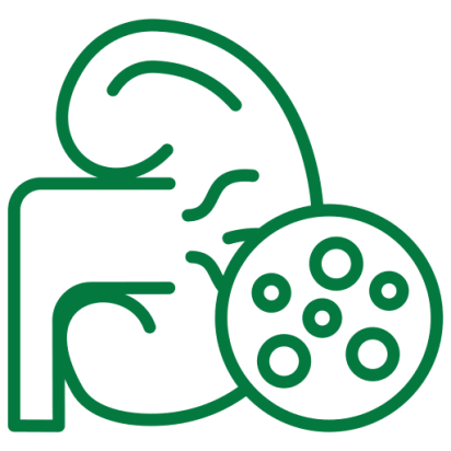 kidney-stone kidney stone treatment in Chennai